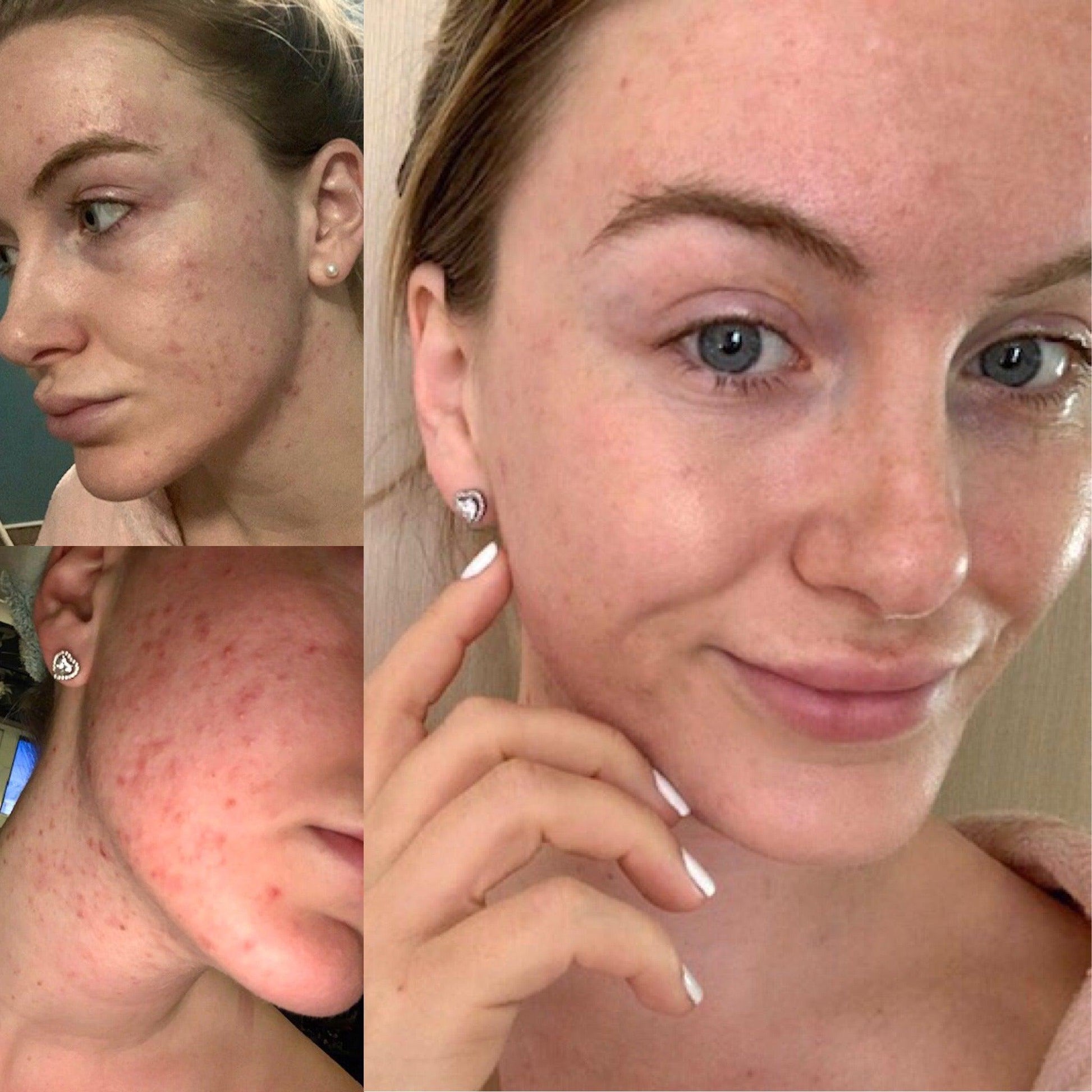 Argan Acne Rehab Serum 30ml Plant Based Formula for Acne Prone Skin